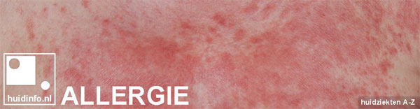 allergie.jpg