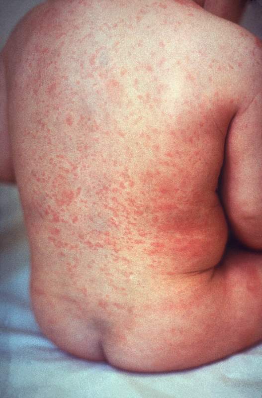 Rash_of_rubella_on_skin_of_child%27s_back.JPG
